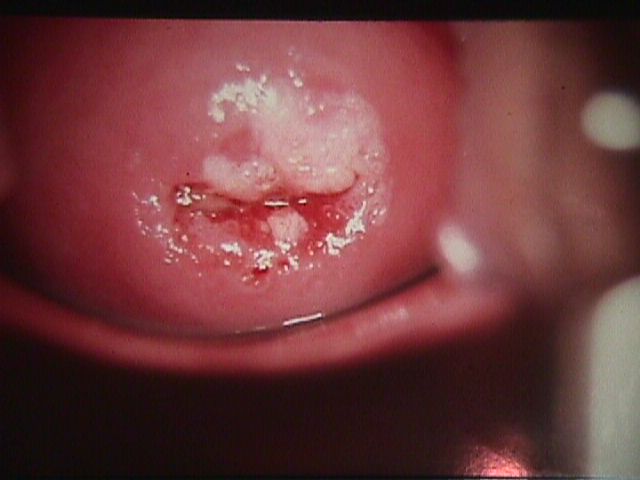 hpv of the vulva Cumshot teen ass tube
